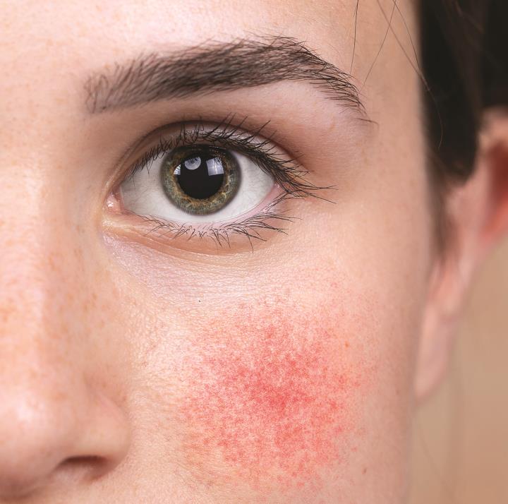 Rosacea.jpg